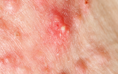 Understanding + Treating Body Acne: Tips for Clearer Skin